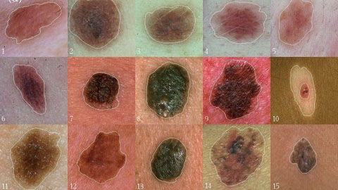 Một số hình ảnh ung thư hắc tố da (Ảnh: melanoma.blogsome.com)